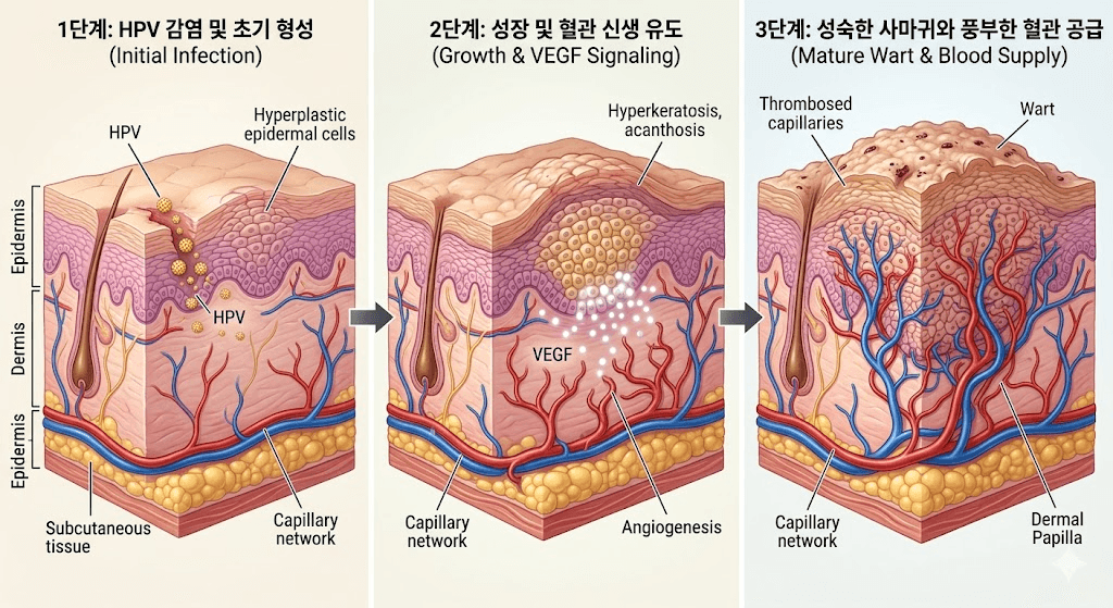 만4세 아기 발가락 사마귀 제거 후기-4