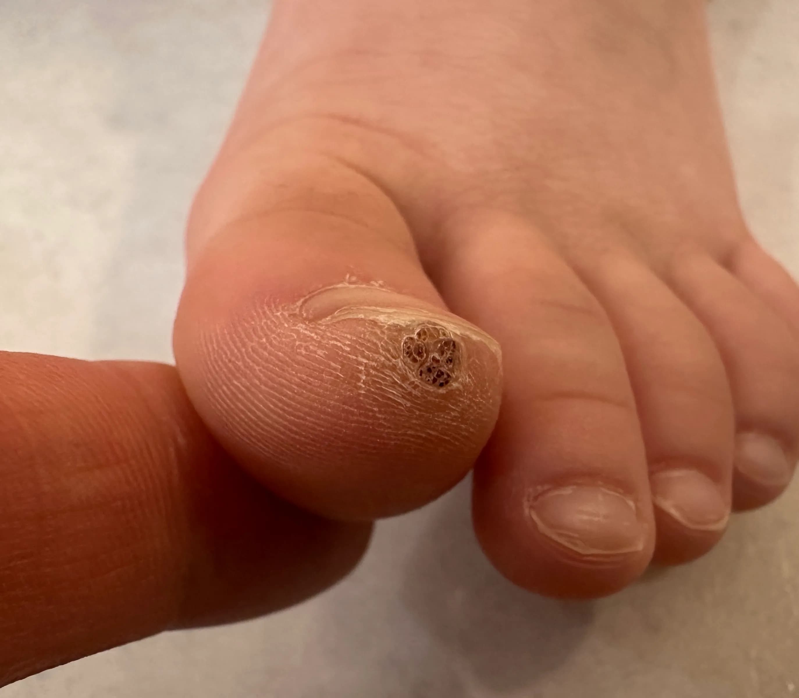 만4세 아기 발가락 사마귀 제거 후기-13