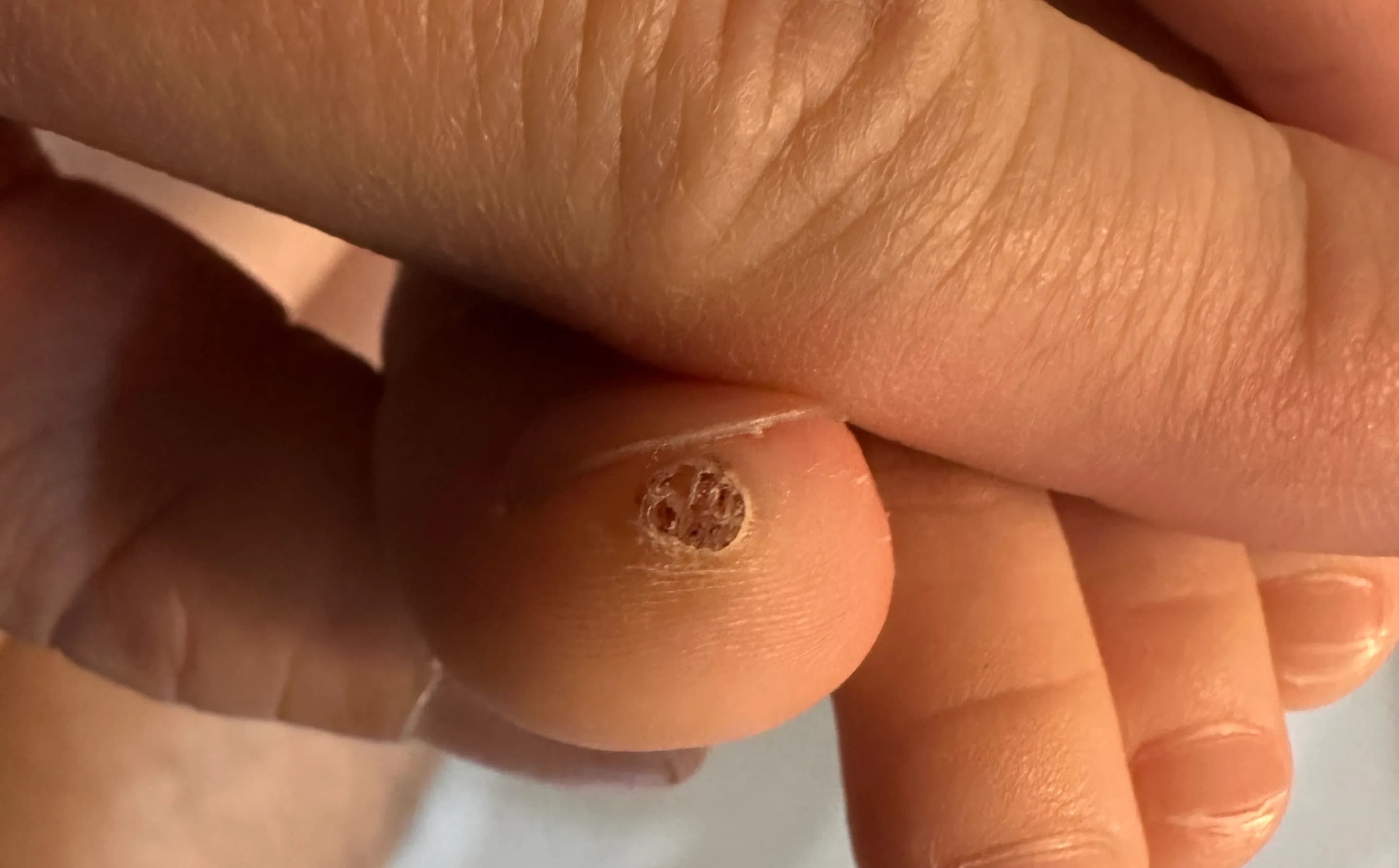 만4세 아기 발가락 사마귀 제거 후기-10