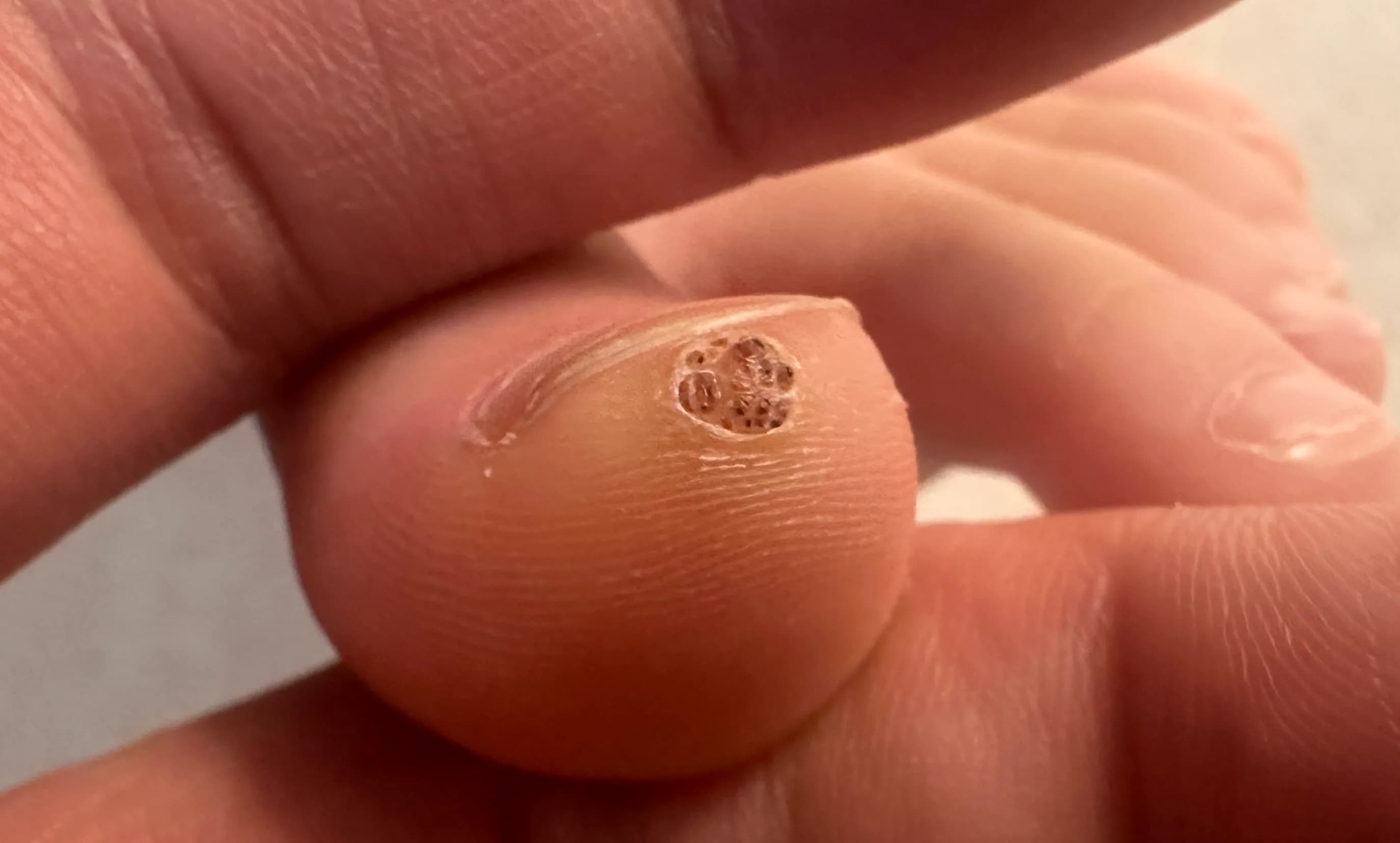 만4세 아기 발가락 사마귀 제거 후기-11